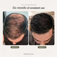 Postgrafts® Topical Scalp Foam