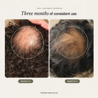 Postgrafts® Topical Scalp Foam