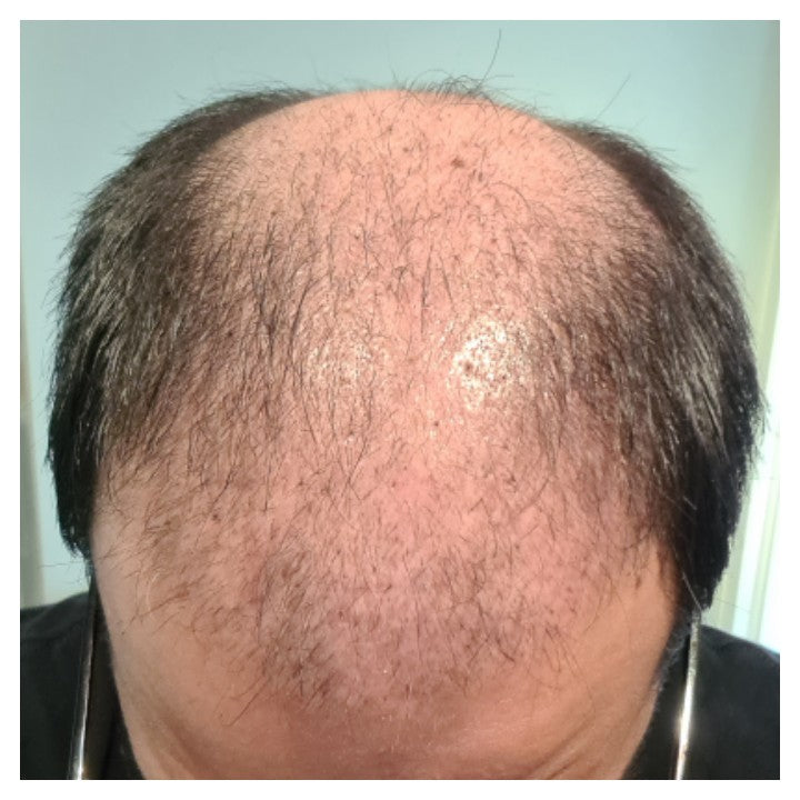 Post-transplant day one